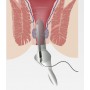Лазерний світловод Biolitec HeLP® (Hemorrhoid Laser Procedure) комплект, Німеччина